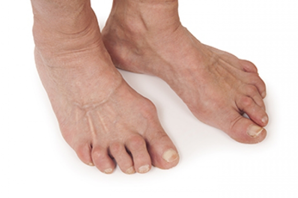 Facts About Rheumatoid Arthritis In The Feet