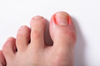 Here's Why You Should Never Ignore an Ingrown Toenail
